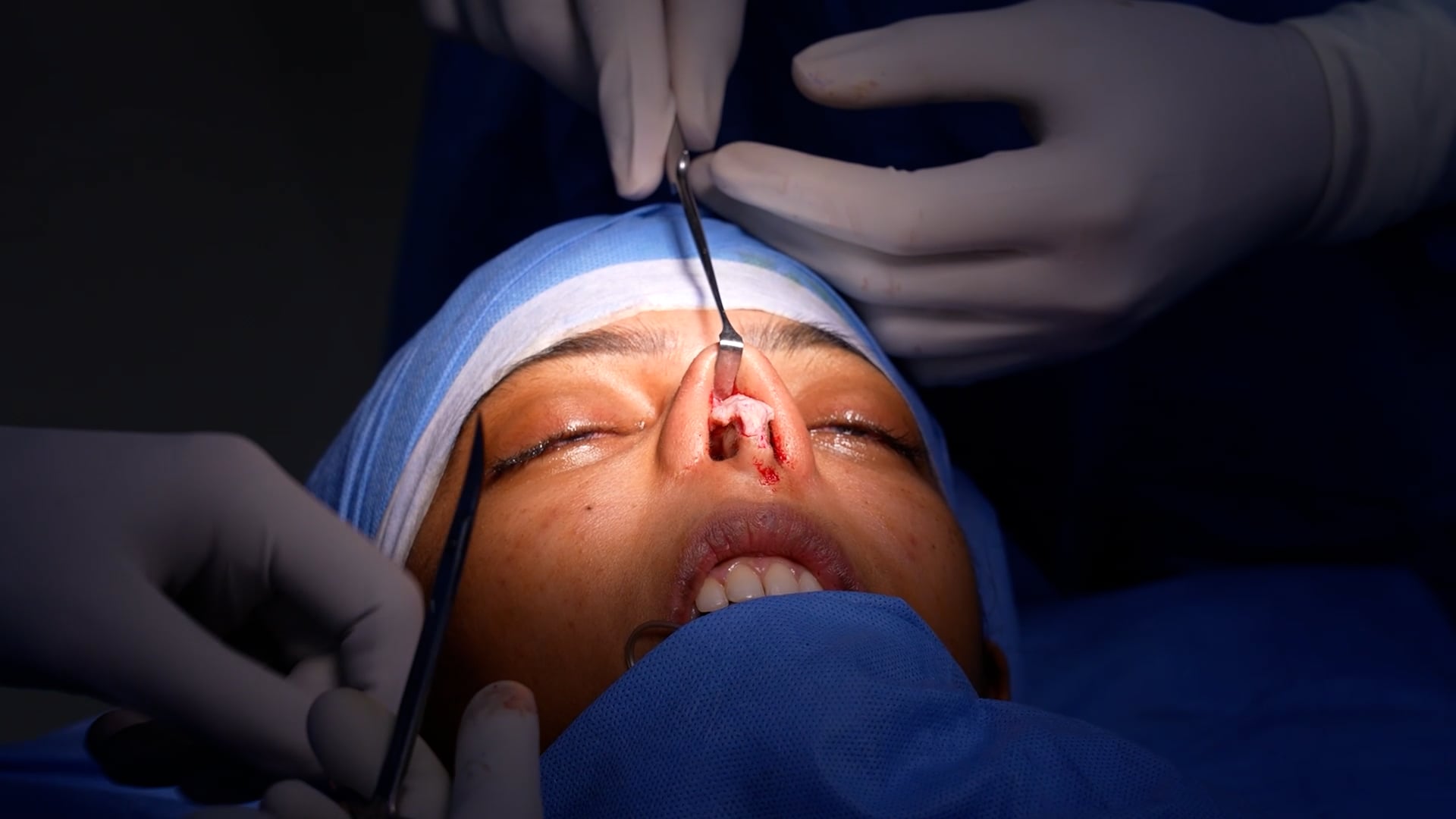 Rhinoplasty for a girl